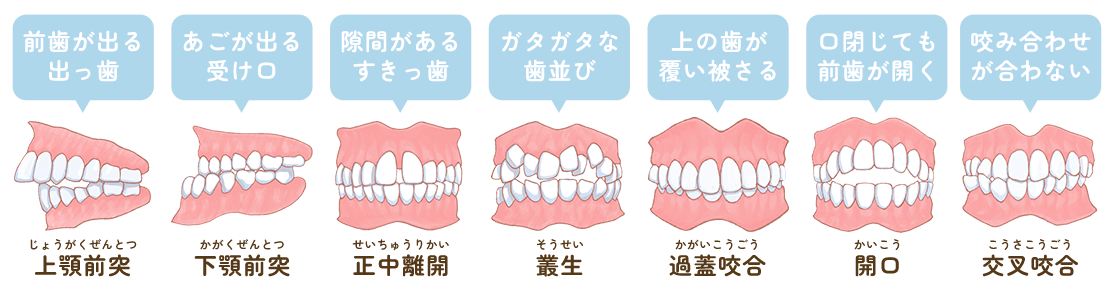 不正咬合