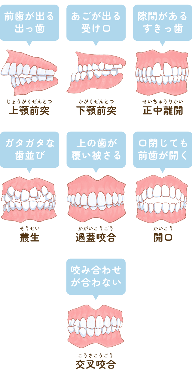 不正咬合