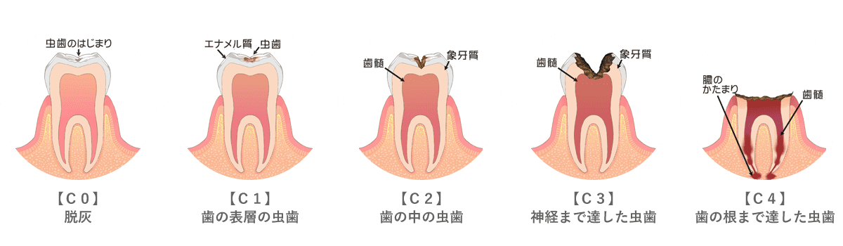 虫歯の進行