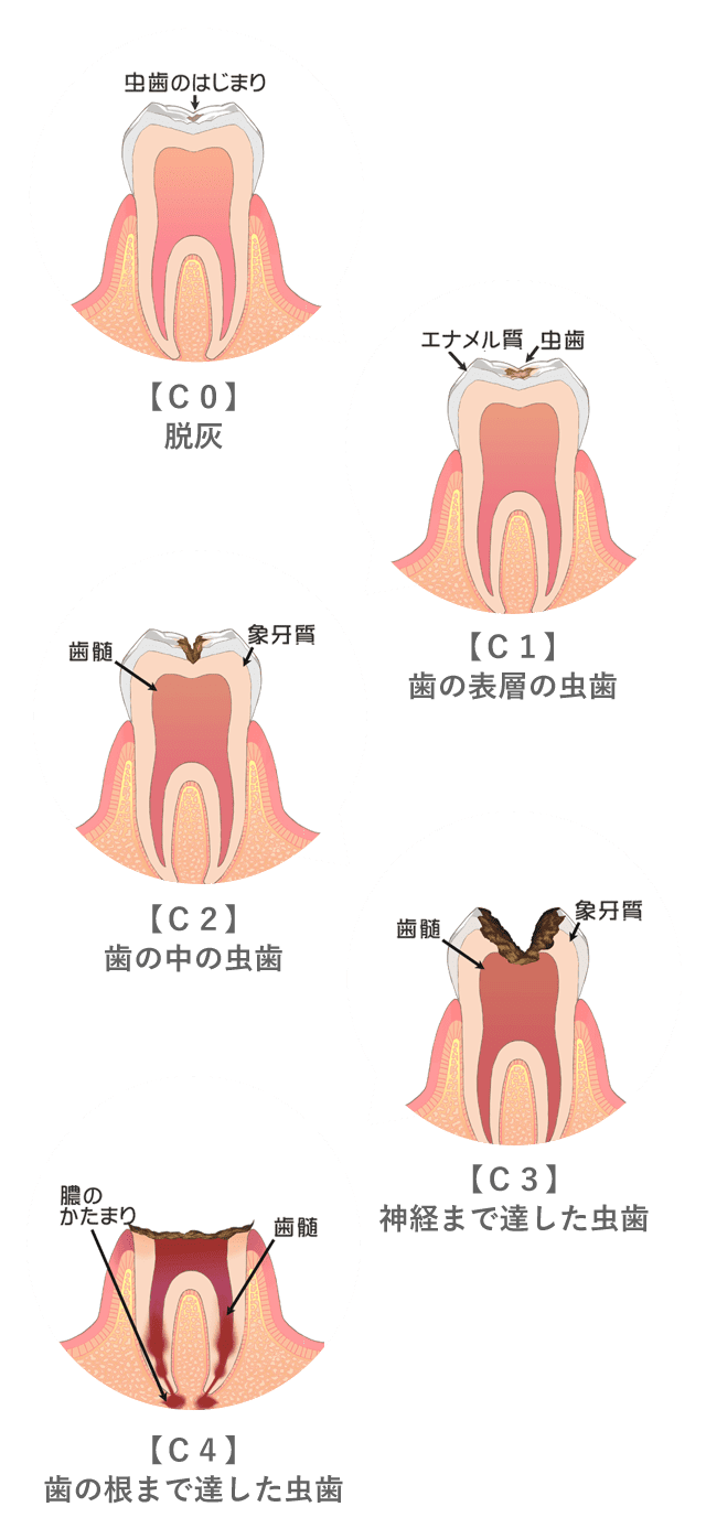 虫歯の進行