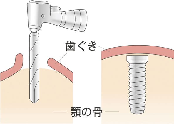 一次手術【インプラント歯根部植立】