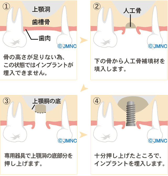 サイナスリフト法