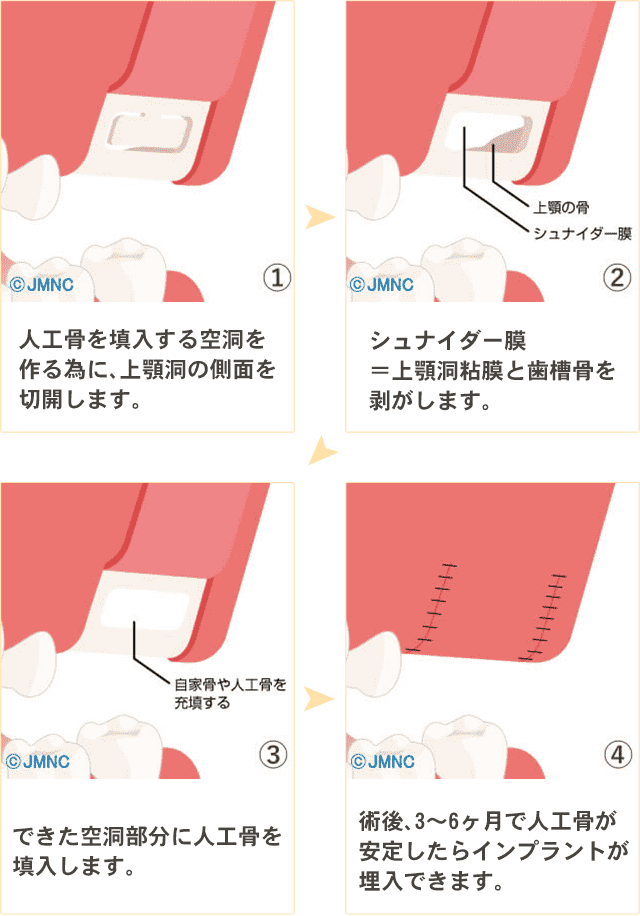 ソケットリフト法