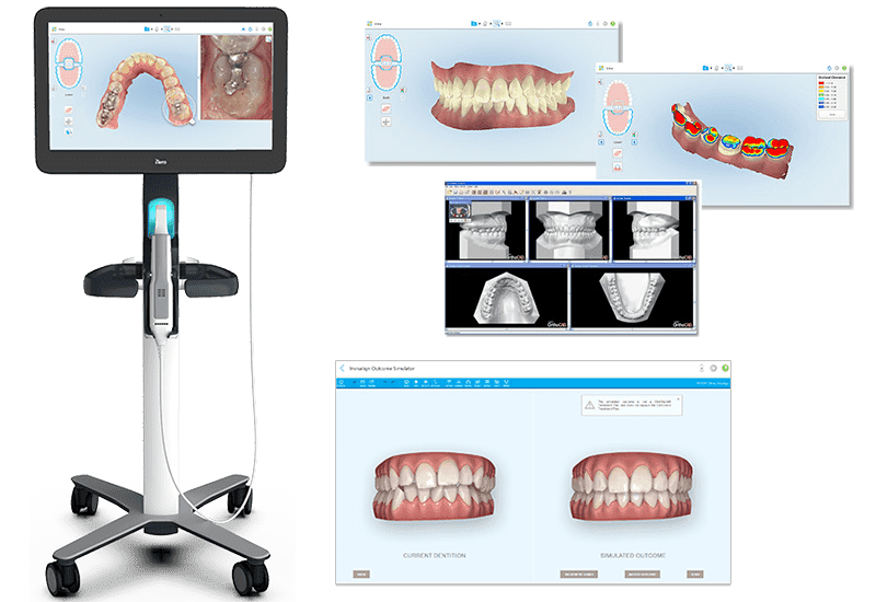 インビザライン専用口腔内スキャナー「iTero